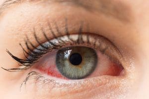 Could you have Dry Eye Syndrome?