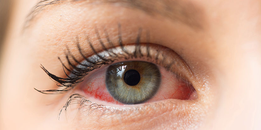 Could you have Dry Eye Syndrome?