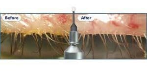 BlephEx treatment for blepharitis