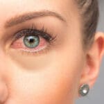 Ocular rosacea treatment at Progressive Vision