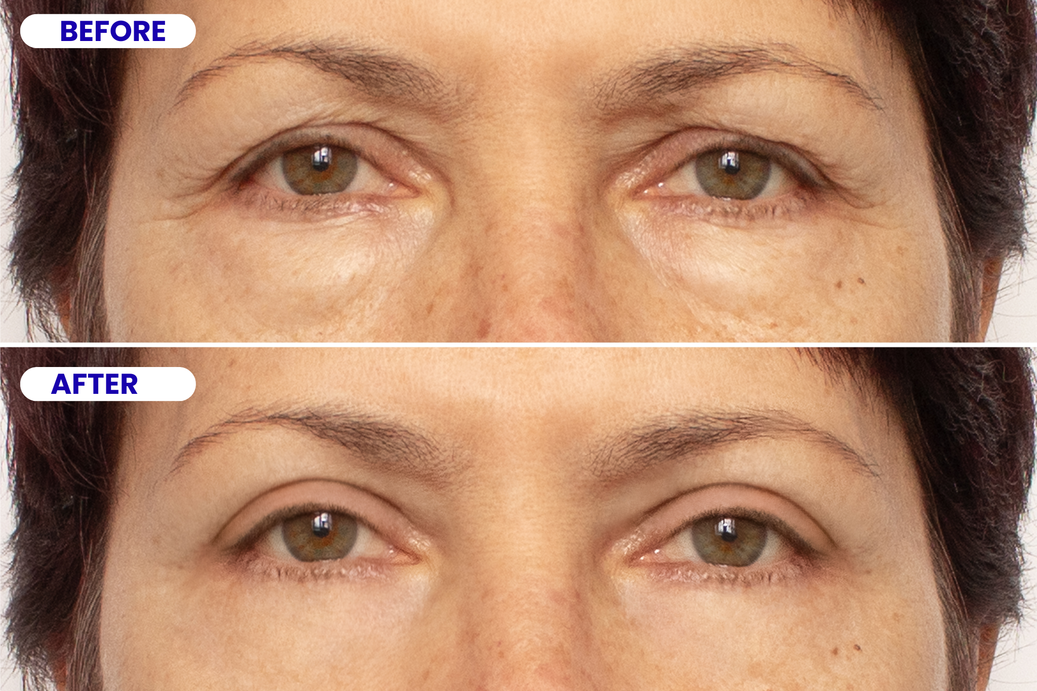 Expert Oculoplastics service now launched at Progressive Vision